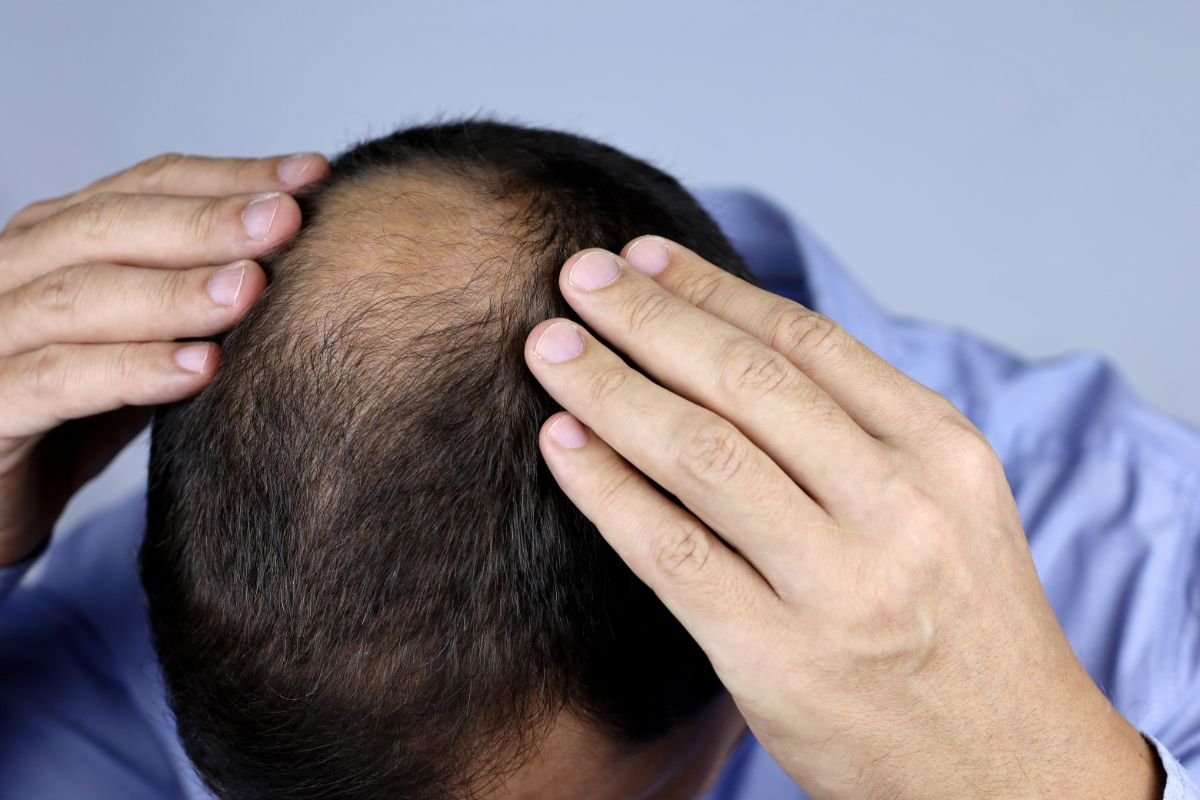 Early Signs and Symptoms of Hair Loss You Shouldn't Ignore